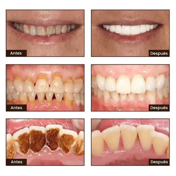 Blanqué – Blanqueamiento potente, sonrisa impecable